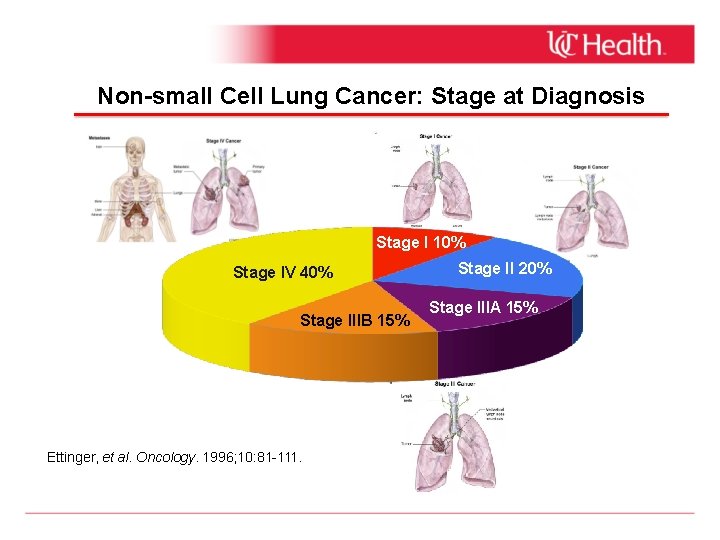 Non-small Cell Lung Cancer: Stage at Diagnosis Stage I 10% Stage IV 40% Stage