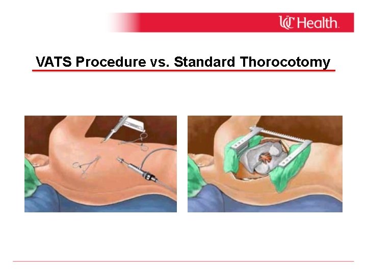 VATS Procedure vs. Standard Thorocotomy 