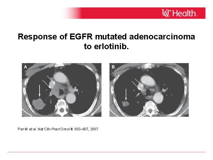 Response of EGFR mutated adenocarcinoma to erlotinib. Pan M et al. Nat Clin Pract
