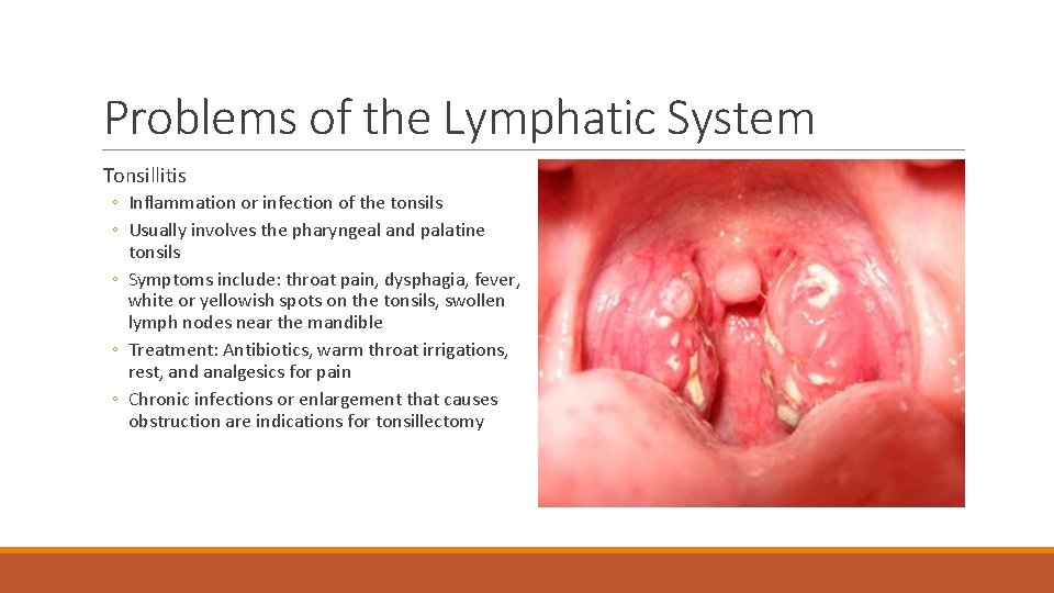 Problems of the Lymphatic System Tonsillitis ◦ Inflammation or infection of the tonsils ◦