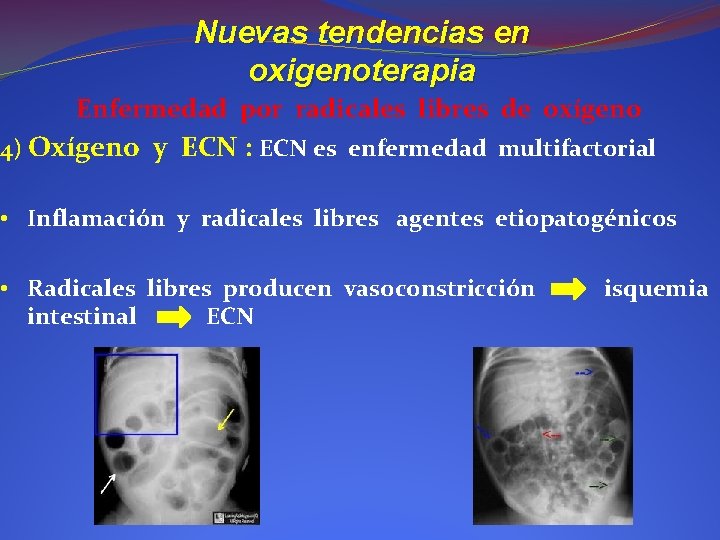 Nuevas tendencias en oxigenoterapia Enfermedad por radicales libres de oxígeno 4) Oxígeno y ECN