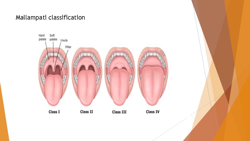 Mallampati classification Mallampati classification