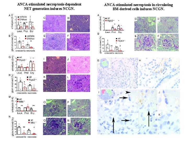 ANCA-stimulated necroptosis-dependent NET generation induces NCGN. ANCA-stimulated necroptosis in circulating BM-derived cells induces NCGN.