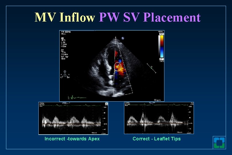 MV Inflow PW SV Placement Incorrect -towards Apex Correct - Leaflet Tips 