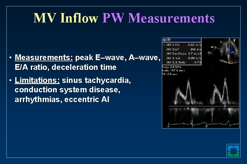 MV Inflow PW Measurements • Measurements: peak E–wave, A–wave, E/A ratio, deceleration time •