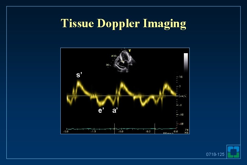 Tissue Doppler Imaging s’ e’ a’ 0718 -125 