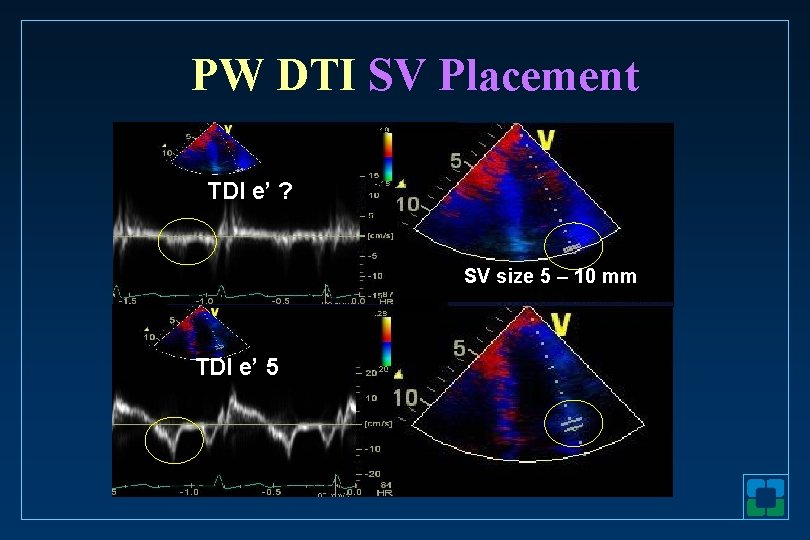 PW DTI SV Placement TDI e’ ? SV size 5 – 10 mm TDI