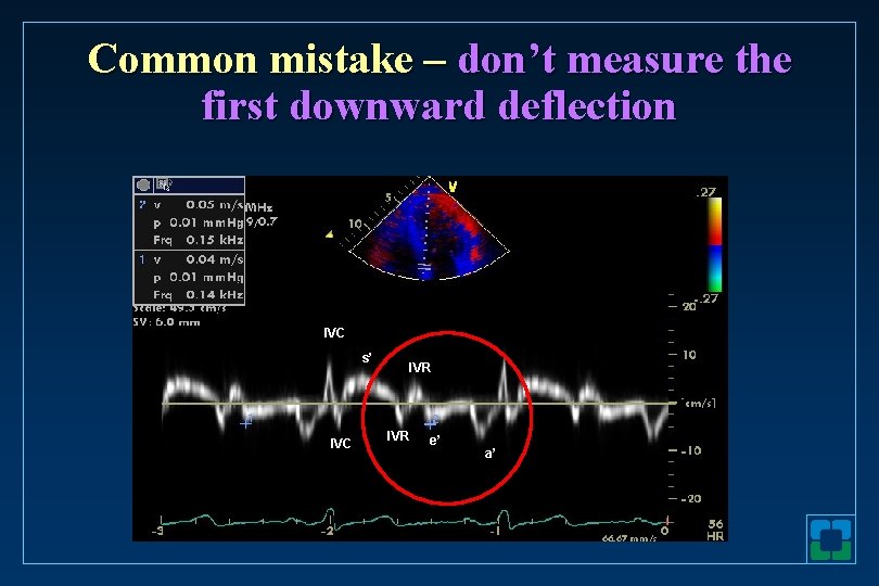 Common mistake – don’t measure the first downward deflection IVC s’ IVC IVR e’