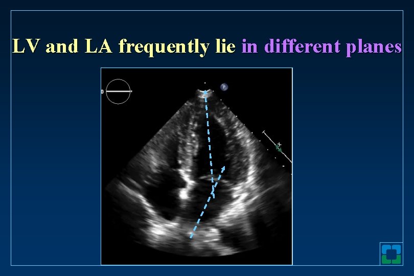 LV and LA frequently lie in different planes 