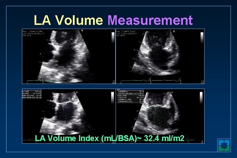 LA Volume Measurement LA Volume Index (m. L/BSA)~ 32. 4 ml/m 2 