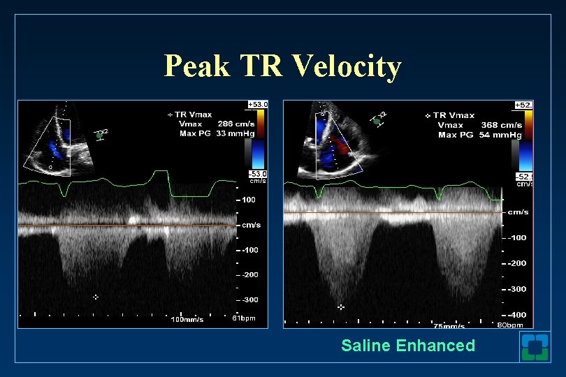 Peak TR Velocity Saline Enhanced 