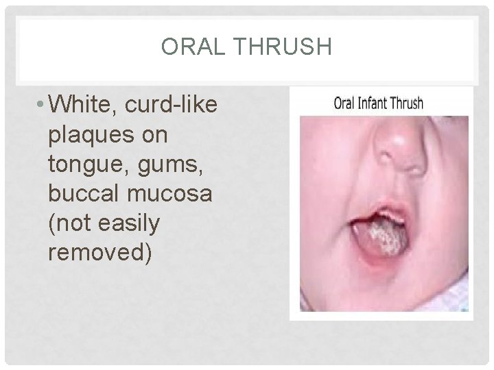 ORAL THRUSH • White, curd-like plaques on tongue, gums, buccal mucosa (not easily removed) ORAL THRUSH • White, curd-like plaques on tongue, gums, buccal mucosa (not easily removed)