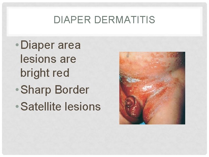 DIAPER DERMATITIS • Diaper area lesions are bright red • Sharp Border • Satellite DIAPER DERMATITIS • Diaper area lesions are bright red • Sharp Border • Satellite
