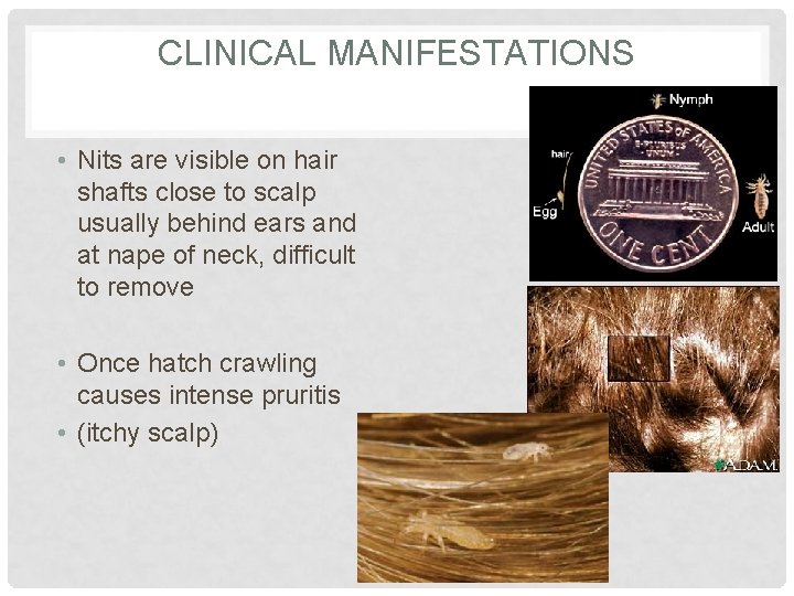 CLINICAL MANIFESTATIONS • Nits are visible on hair shafts close to scalp usually behind CLINICAL MANIFESTATIONS • Nits are visible on hair shafts close to scalp usually behind