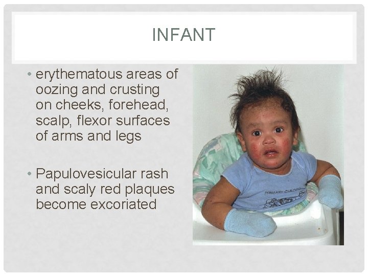 INFANT • erythematous areas of oozing and crusting on cheeks, forehead, scalp, flexor surfaces INFANT • erythematous areas of oozing and crusting on cheeks, forehead, scalp, flexor surfaces