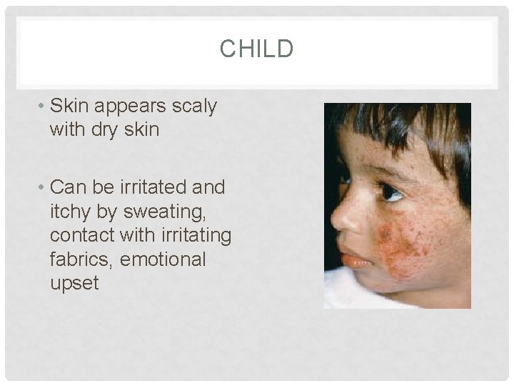 CHILD • Skin appears scaly with dry skin • Can be irritated and itchy CHILD • Skin appears scaly with dry skin • Can be irritated and itchy