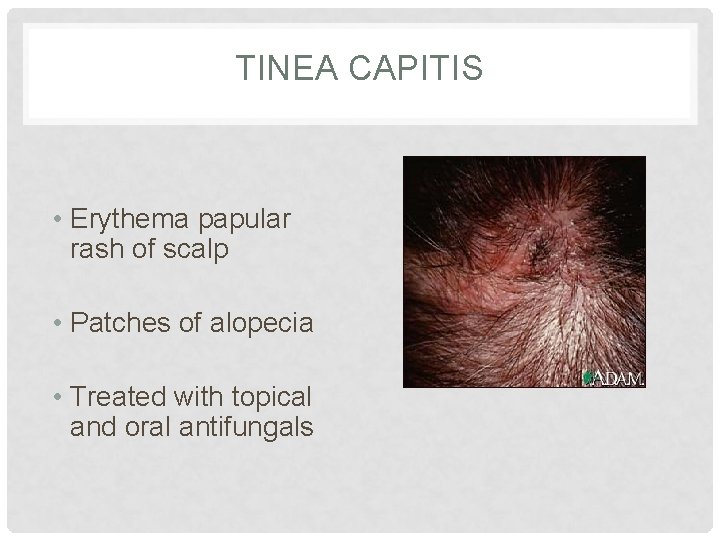 TINEA CAPITIS • Erythema papular rash of scalp • Patches of alopecia • Treated TINEA CAPITIS • Erythema papular rash of scalp • Patches of alopecia • Treated