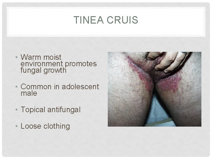 TINEA CRUIS • Warm moist environment promotes fungal growth • Common in adolescent male TINEA CRUIS • Warm moist environment promotes fungal growth • Common in adolescent male