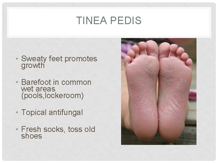 TINEA PEDIS • Sweaty feet promotes growth • Barefoot in common wet areas (pools, TINEA PEDIS • Sweaty feet promotes growth • Barefoot in common wet areas (pools,