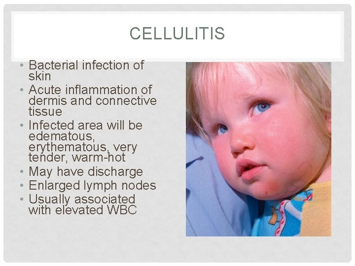 CELLULITIS • Bacterial infection of skin • Acute inflammation of dermis and connective tissue CELLULITIS • Bacterial infection of skin • Acute inflammation of dermis and connective tissue