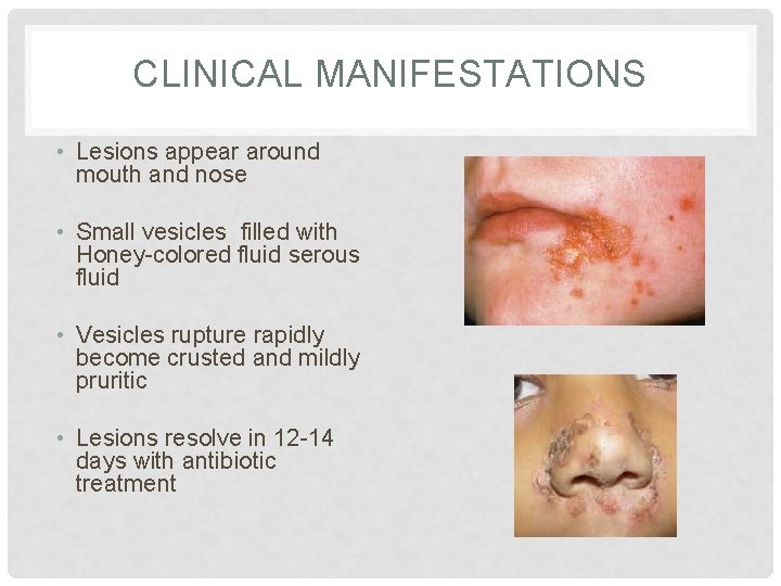 CLINICAL MANIFESTATIONS • Lesions appear around mouth and nose • Small vesicles filled with CLINICAL MANIFESTATIONS • Lesions appear around mouth and nose • Small vesicles filled with