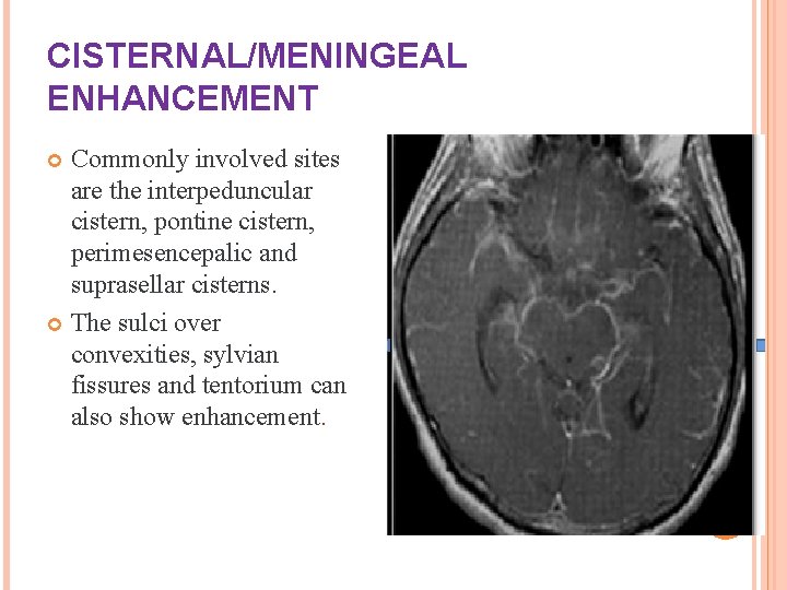 CISTERNAL/MENINGEAL ENHANCEMENT Commonly involved sites are the interpeduncular cistern, pontine cistern, perimesencepalic and suprasellar