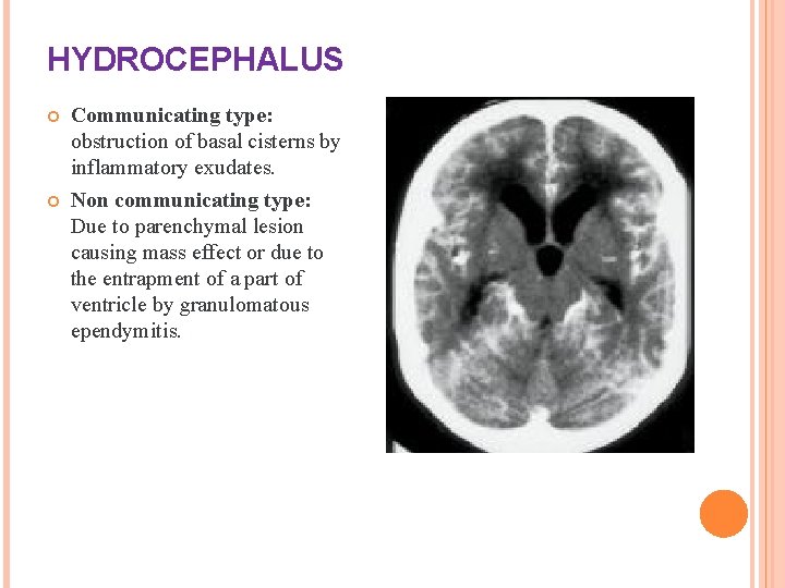 HYDROCEPHALUS Communicating type: obstruction of basal cisterns by inflammatory exudates. Non communicating type: Due