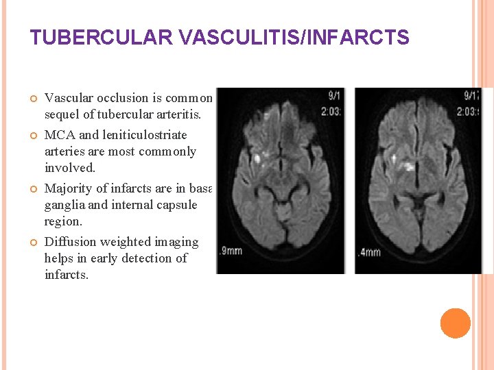 TUBERCULAR VASCULITIS/INFARCTS Vascular occlusion is common sequel of tubercular arteritis. MCA and leniticulostriate arteries