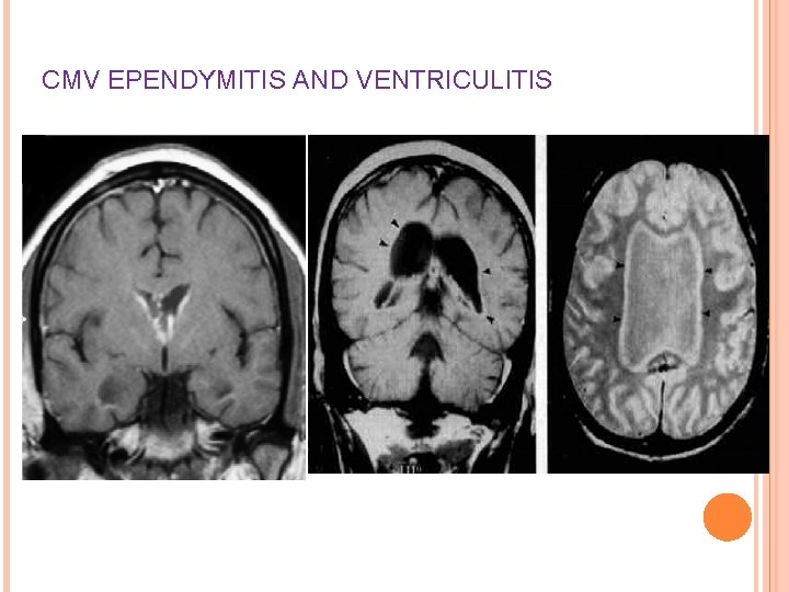 CMV EPENDYMITIS AND VENTRICULITIS 