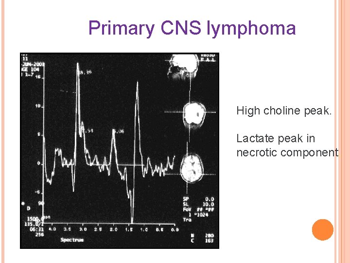 Primary CNS lymphoma High choline peak. Lactate peak in necrotic component. 