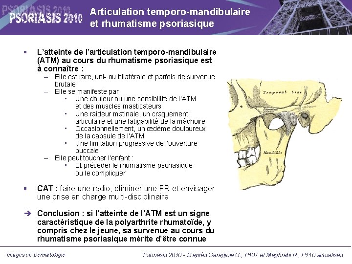 Articulation temporo-mandibulaire et rhumatisme psoriasique L’atteinte de l’articulation temporo-mandibulaire (ATM) au cours du rhumatisme Articulation temporo-mandibulaire et rhumatisme psoriasique L’atteinte de l’articulation temporo-mandibulaire (ATM) au cours du rhumatisme