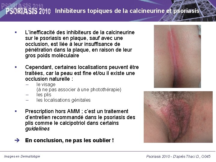 Inhibiteurs topiques de la calcineurine et psoriasis L’inefficacité des inhibiteurs de la calcineurine sur Inhibiteurs topiques de la calcineurine et psoriasis L’inefficacité des inhibiteurs de la calcineurine sur