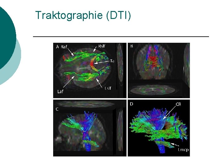 Traktographie (DTI) 