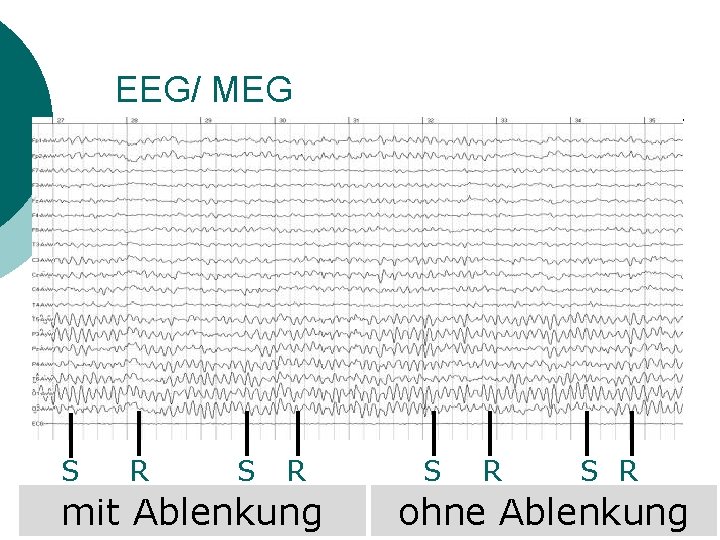 EEG/ MEG S R mit Ablenkung S R ohne Ablenkung 