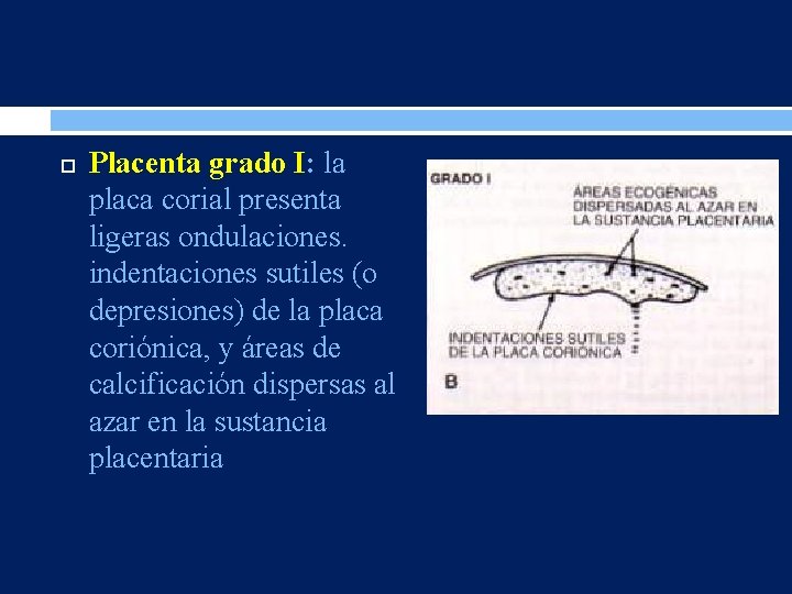  Placenta grado I: la placa corial presenta ligeras ondulaciones. indentaciones sutiles (o depresiones)