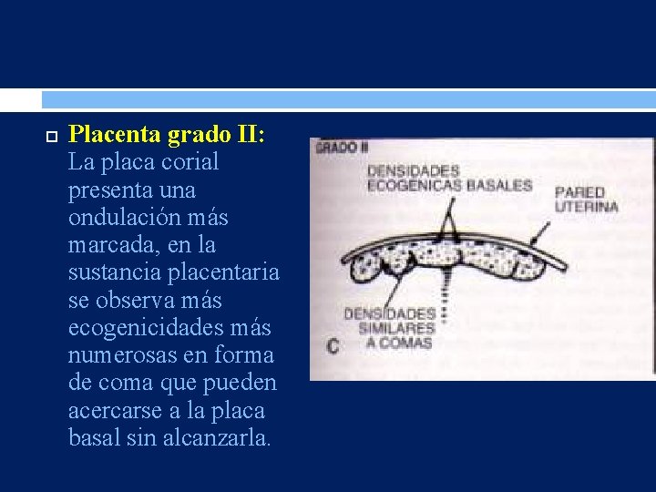  Placenta grado II: La placa corial presenta una ondulación más marcada, en la