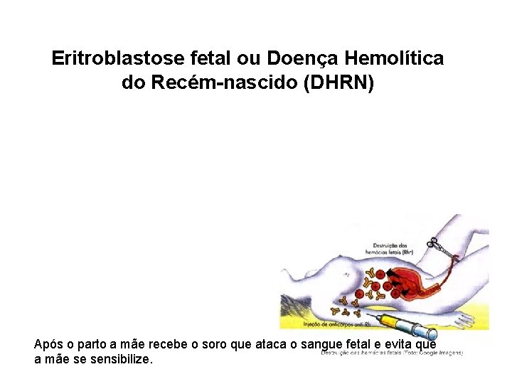 Eritroblastose fetal ou Doença Hemolítica do Recém-nascido (DHRN) Após o parto a mãe recebe
