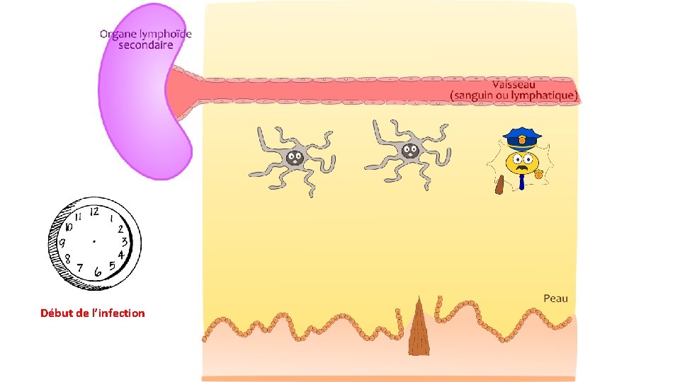 Début de l’infection 