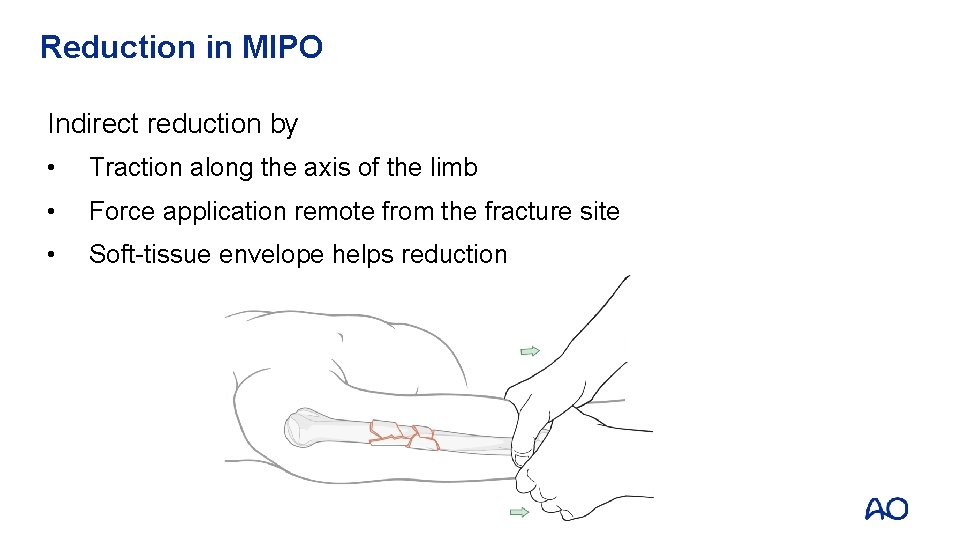 Reduction in MIPO Indirect reduction by • Traction along the axis of the limb