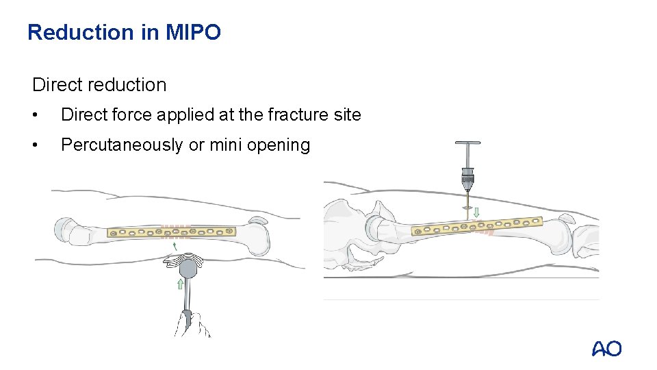 Reduction in MIPO Direct reduction • Direct force applied at the fracture site •