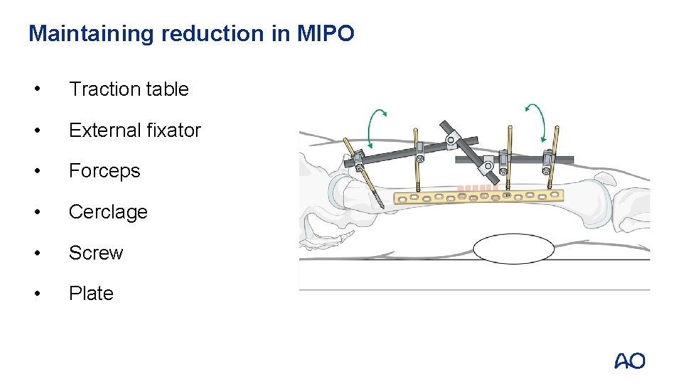 Maintaining reduction in MIPO • Traction table • External fixator • Forceps • Cerclage Maintaining reduction in MIPO • Traction table • External fixator • Forceps • Cerclage
