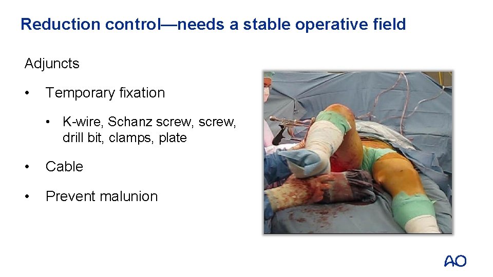 Reduction control—needs a stable operative field Adjuncts • Temporary fixation • K-wire, Schanz screw,