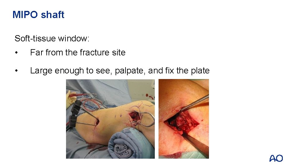 MIPO shaft Soft-tissue window: • Far from the fracture site • Large enough to