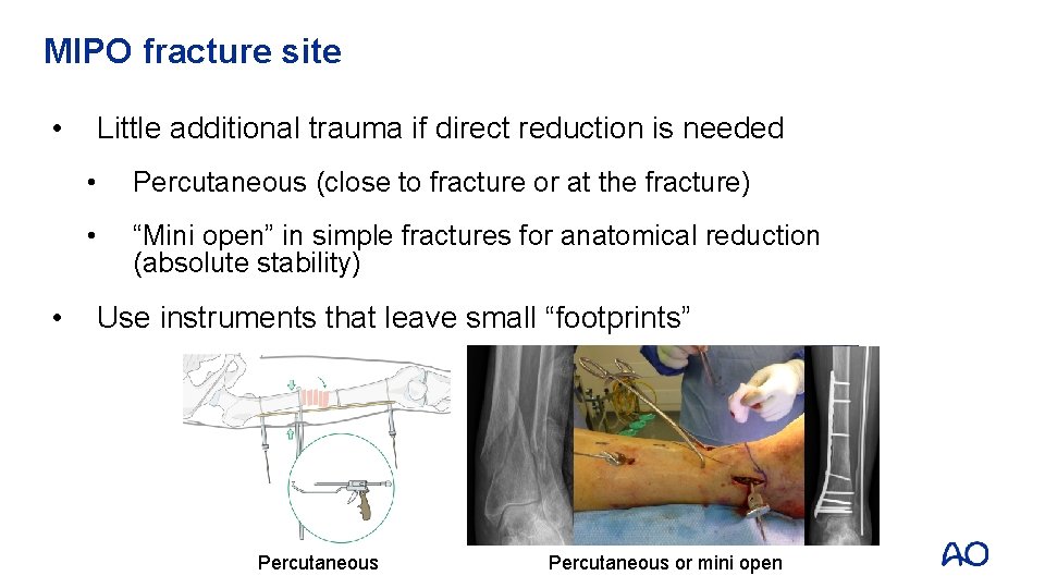 MIPO fracture site • • Little additional trauma if direct reduction is needed •