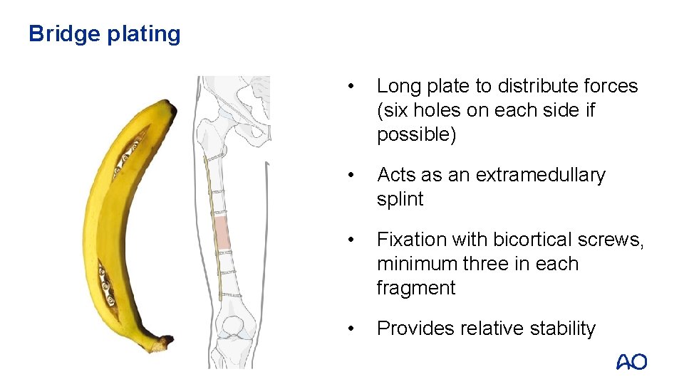 Bridge plating • Long plate to distribute forces (six holes on each side if