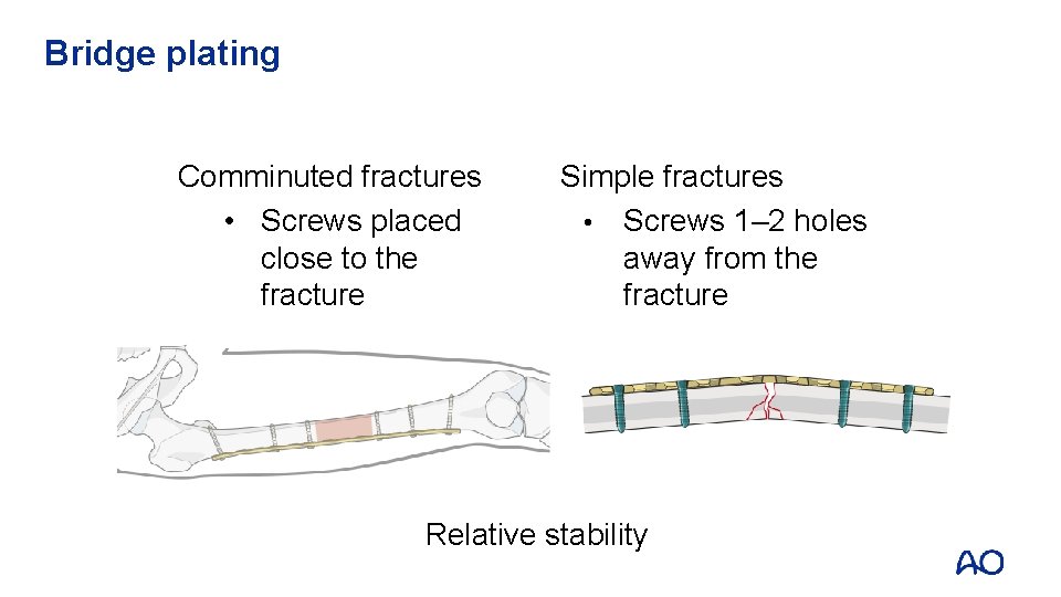Bridge plating Comminuted fractures • Screws placed close to the fracture Simple fractures • Bridge plating Comminuted fractures • Screws placed close to the fracture Simple fractures •