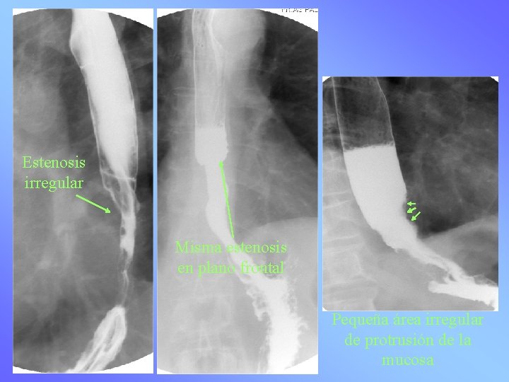 Estenosis irregular Misma estenosis en plano frontal Pequeña área irregular de protrusión de la