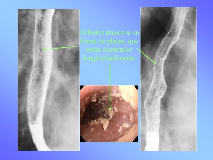 Defectos mucosos en forma de placas, que están orientados longitudinalmente 