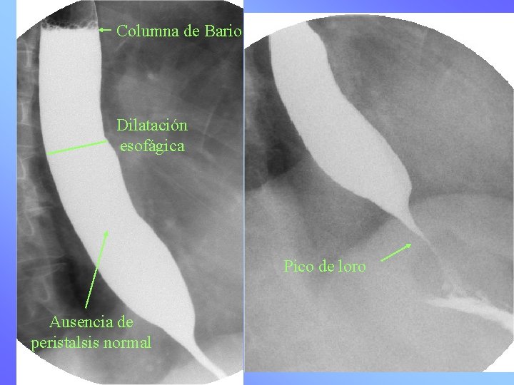 Columna de Bario Dilatación esofágica Pico de loro Ausencia de peristalsis normal 
