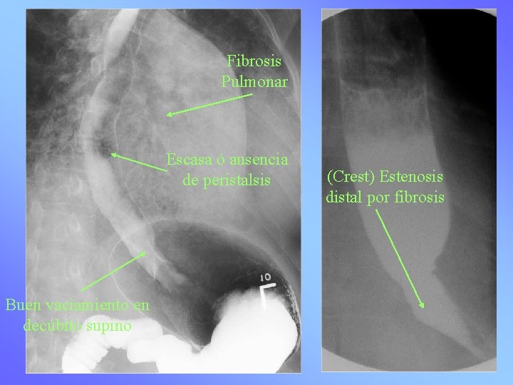 Fibrosis Pulmonar Escasa ó ausencia de peristalsis Buen vaciamiento en decúbito supino (Crest) Estenosis